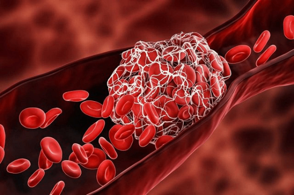 Tác nghẽn mạch máu: Nguyên nhân, triệu chứng và cách phòng ngừa