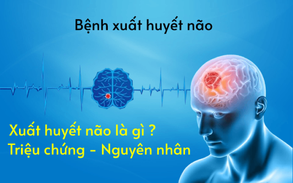 Bệnh xuất huyết não có chữa được không?