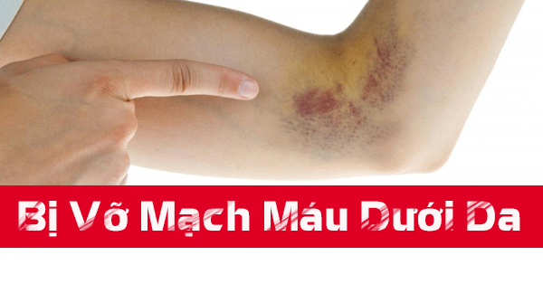 Vỡ mạch máu dưới da