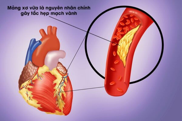 Yếu tố gây ra xơ hẹp động mạch vành