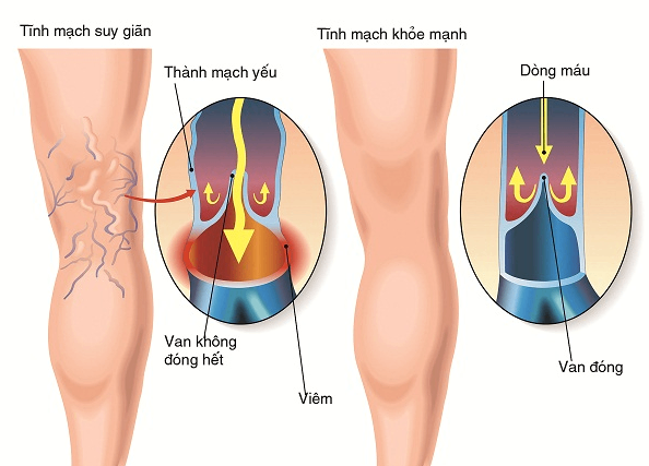 Biện pháp cải thiện - phòng ngừa giãn tĩnh mạch chân